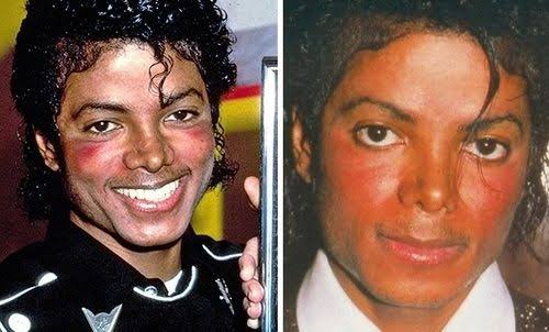 O lúpus afetou Michael Jackson, por enfraquecer o cantor - Foto: Reprodução